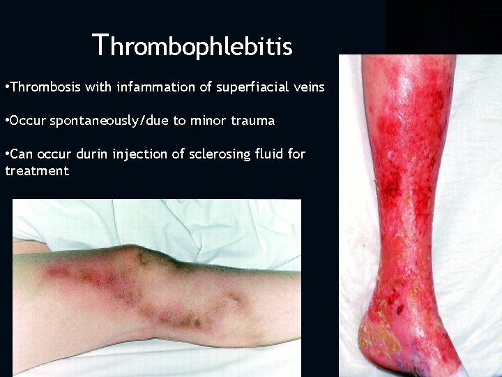 Thrombophlebitis • Thrombosis with infammation of superfiacial veins • Occur spontaneously/due to minor trauma