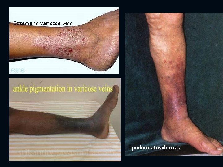 Eczema in varicose vein lipodermatosclerosis 