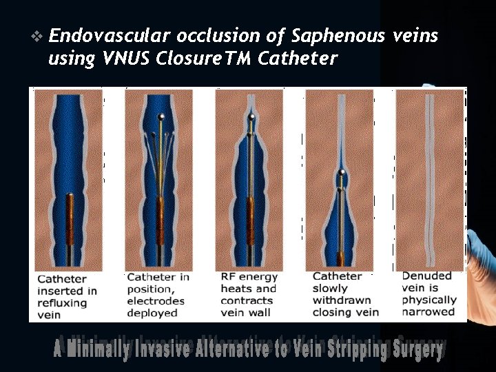 v Endovascular occlusion of Saphenous veins using VNUS Closure. TM Catheter 