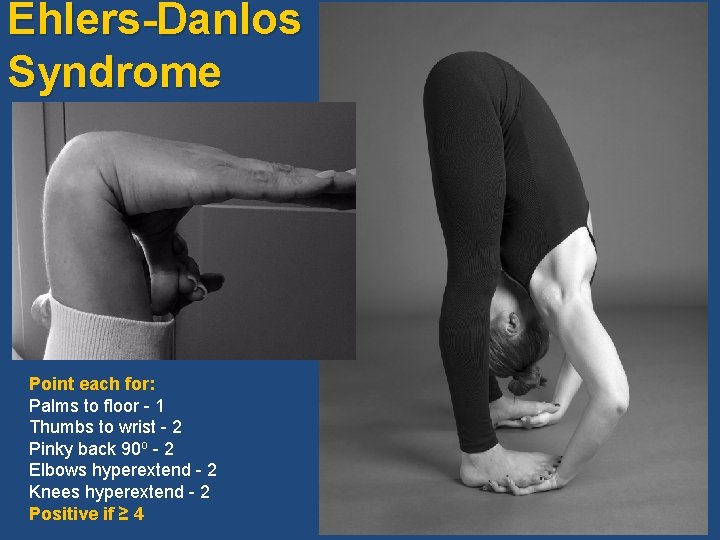 Ehlers-Danlos Syndrome Point each for: Palms to floor - 1 Thumbs to wrist -