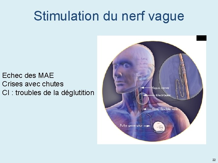 Stimulation du nerf vague Echec des MAE Crises avec chutes CI : troubles de