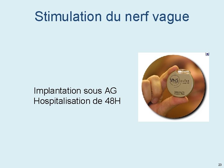 Stimulation du nerf vague Implantation sous AG Hospitalisation de 48 H 23 