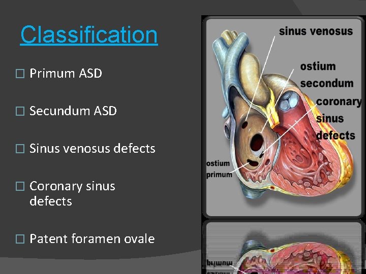 Classification � Primum ASD � Secundum ASD � Sinus venosus defects � Coronary sinus