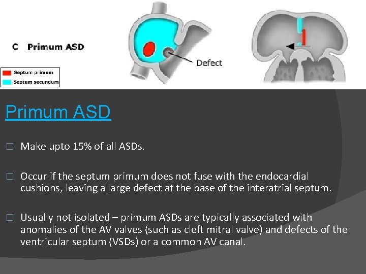 Primum ASD � Make upto 15% of all ASDs. � Occur if the septum