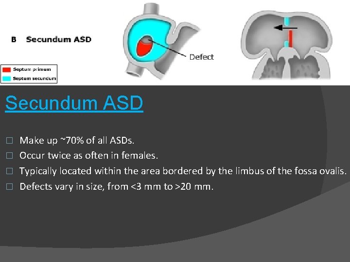 Secundum ASD Make up ~70% of all ASDs. � Occur twice as often in