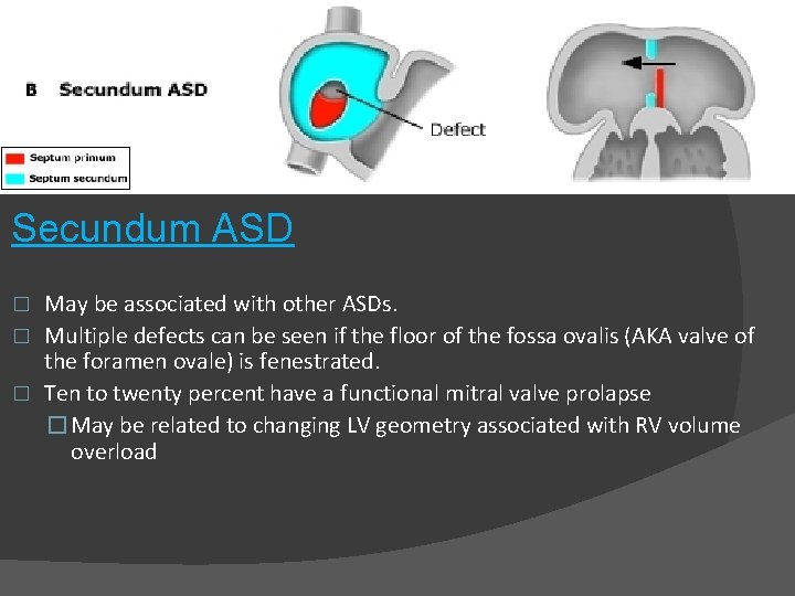 Secundum ASD May be associated with other ASDs. � Multiple defects can be seen