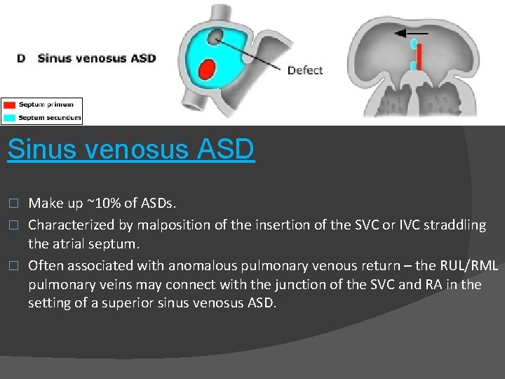 Sinus venosus ASD Make up ~10% of ASDs. � Characterized by malposition of the