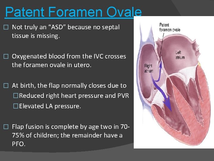 Patent Foramen Ovale � Not truly an “ASD” because no septal tissue is missing.