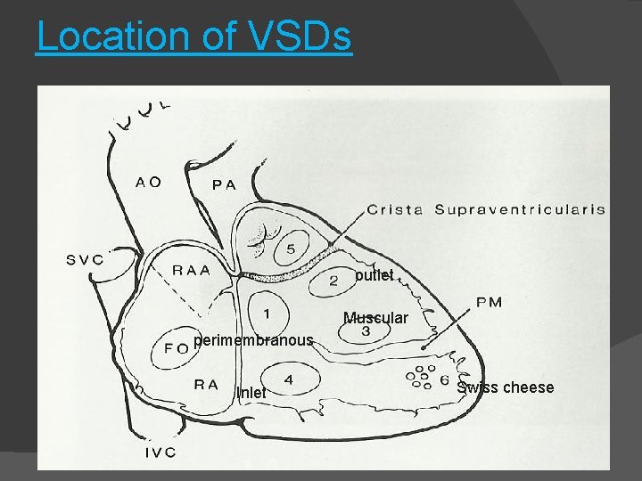 Location of VSDs outlet Muscular perimembranous Inlet Swiss cheese 
