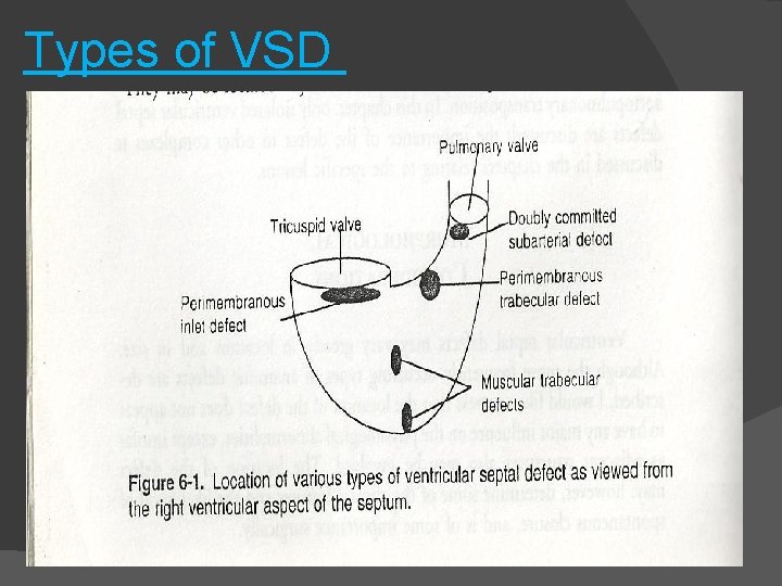 Types of VSD 