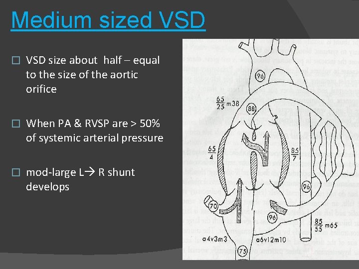 Medium sized VSD � VSD size about half – equal to the size of