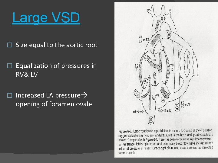 Large VSD � Size equal to the aortic root � Equalization of pressures in