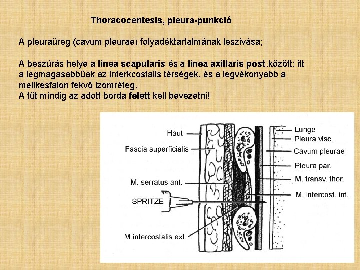 Thoracocentesis, pleura-punkció A pleuraüreg (cavum pleurae) folyadéktartalmának leszivása; A beszúrás helye a linea scapularis