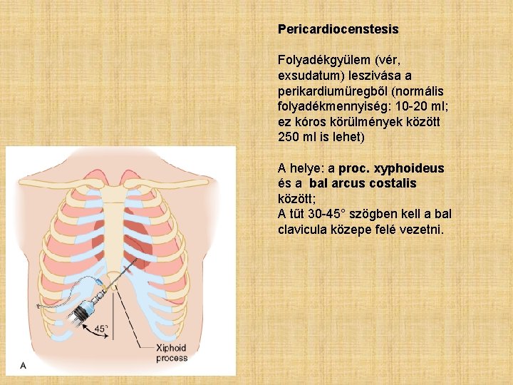 Pericardiocenstesis Folyadékgyülem (vér, exsudatum) leszivása a perikardiumüregből (normális folyadékmennyiség: 10 -20 ml; ez kóros