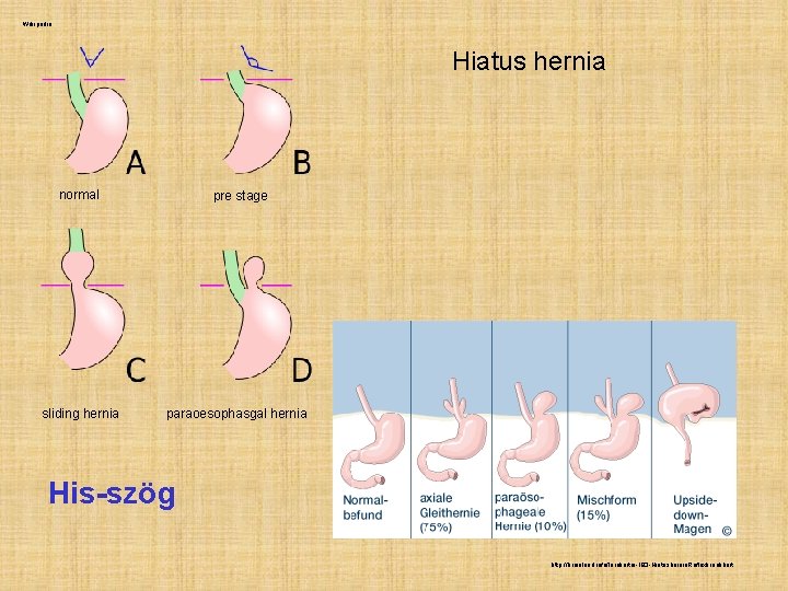 Wikipedia Hiatus hernia normal sliding hernia pre stage paraoesophasgal hernia His-szög http: //brainload. info/lernkartei-183 Wikipedia Hiatus hernia normal sliding hernia pre stage paraoesophasgal hernia His-szög http: //brainload. info/lernkartei-183