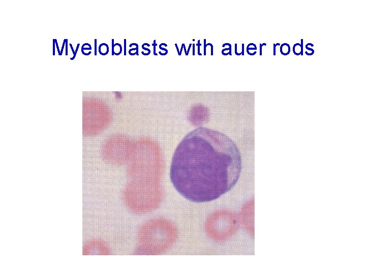 Myeloblasts with auer rods 