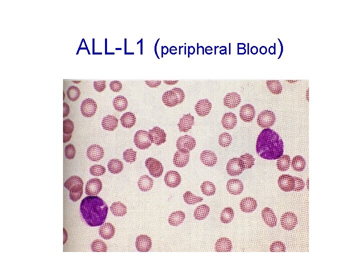 ALL-L 1 (peripheral Blood) 