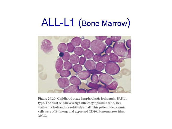 ALL-L 1 (Bone Marrow) 