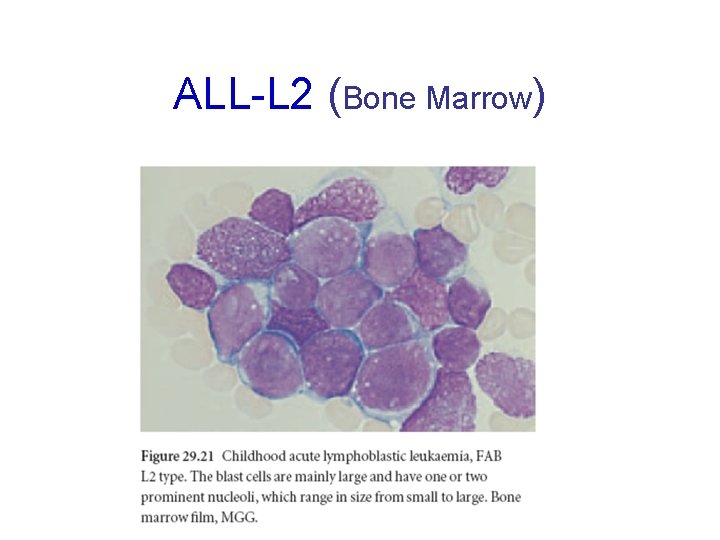 ALL-L 2 (Bone Marrow) 