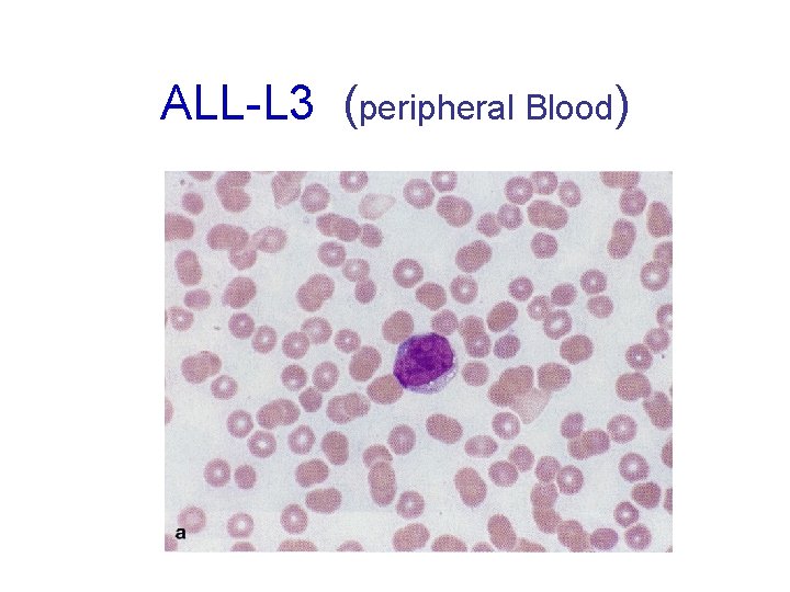 ALL-L 3 (peripheral Blood) 