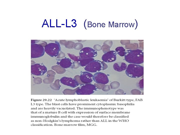 ALL-L 3 (Bone Marrow) 