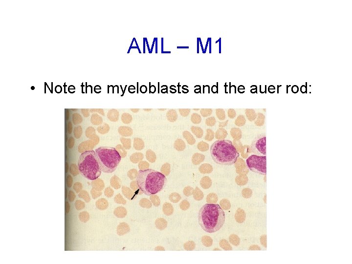 AML – M 1 • Note the myeloblasts and the auer rod: 