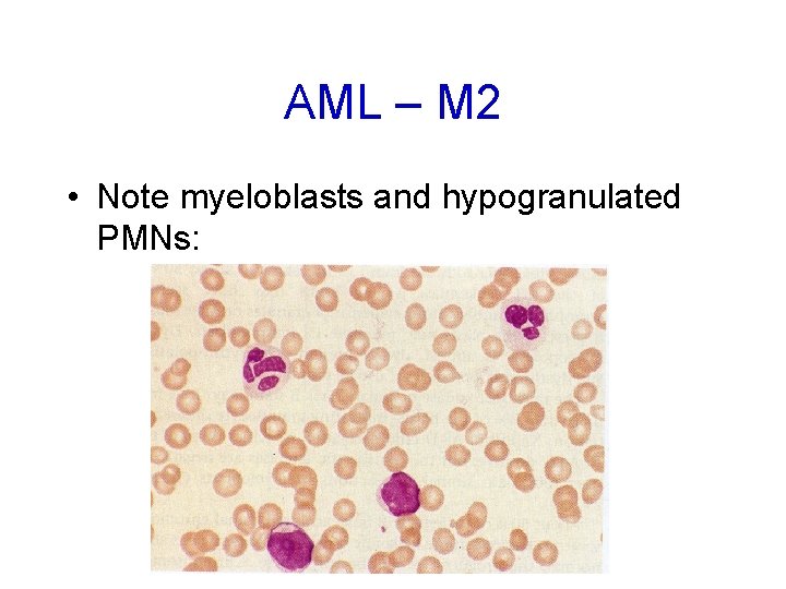 AML – M 2 • Note myeloblasts and hypogranulated PMNs: 