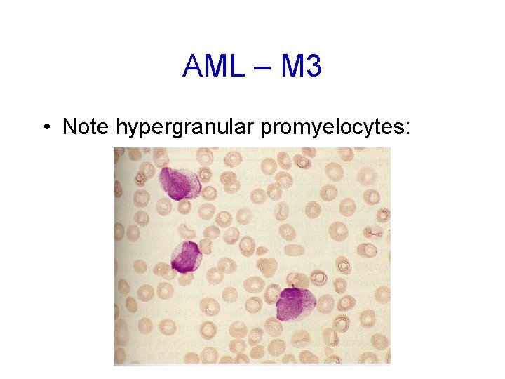 AML – M 3 • Note hypergranular promyelocytes: 