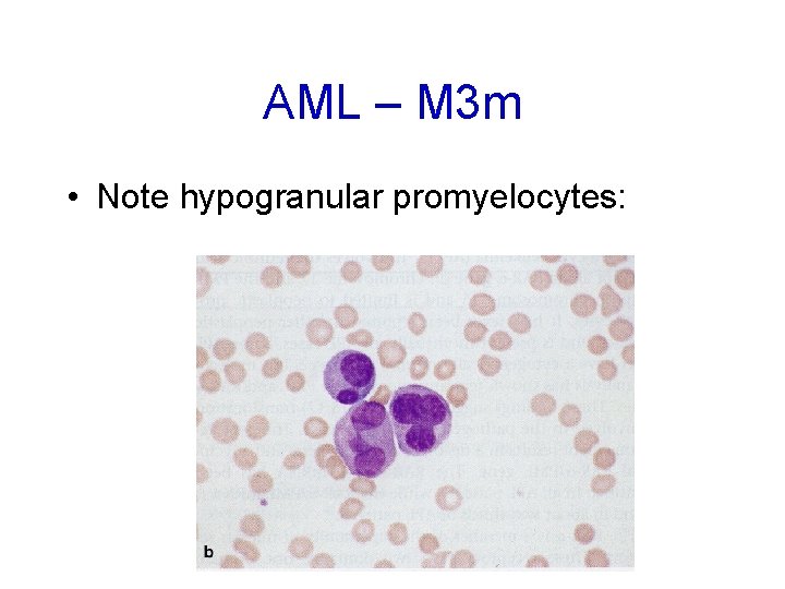 AML – M 3 m • Note hypogranular promyelocytes: 