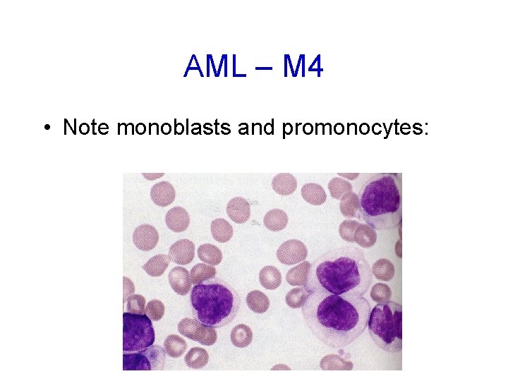 AML – M 4 • Note monoblasts and promonocytes: 