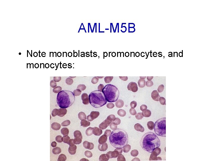 AML-M 5 B • Note monoblasts, promonocytes, and monocytes: 
