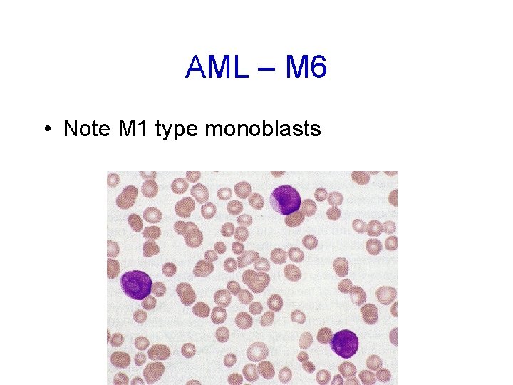 AML – M 6 • Note M 1 type monoblasts 