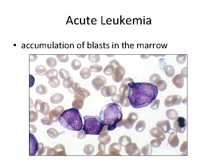 Acute Leukemia • accumulation of blasts in the marrow 