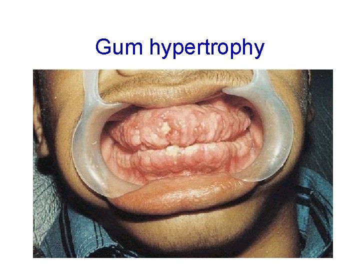Gum hypertrophy 