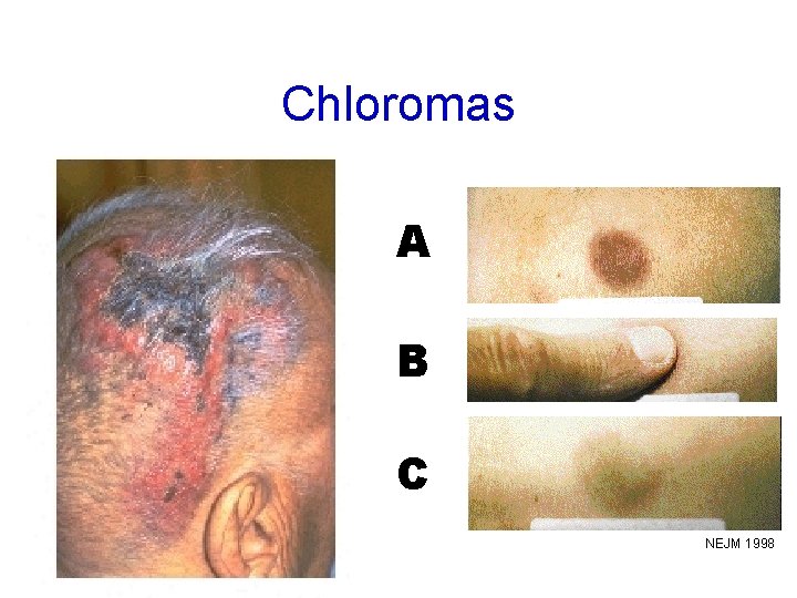 Chloromas A B C NEJM 1998 