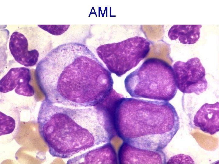 AML 