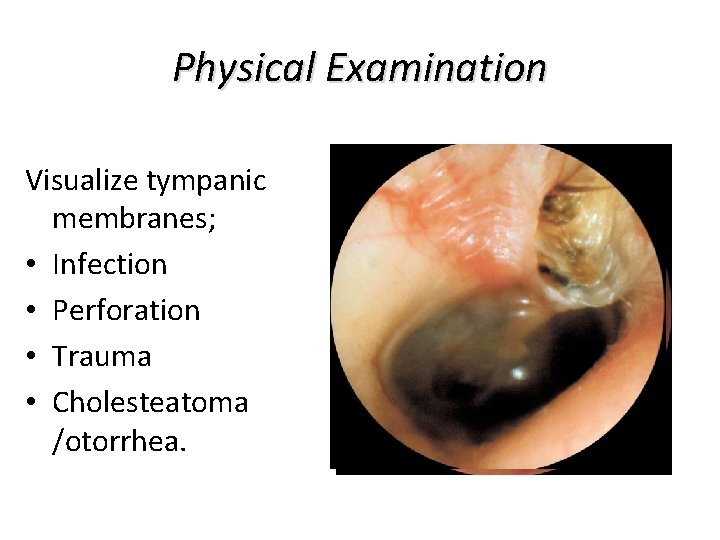 Physical Examination Visualize tympanic membranes; • Infection • Perforation • Trauma • Cholesteatoma /otorrhea. Physical Examination Visualize tympanic membranes; • Infection • Perforation • Trauma • Cholesteatoma /otorrhea.