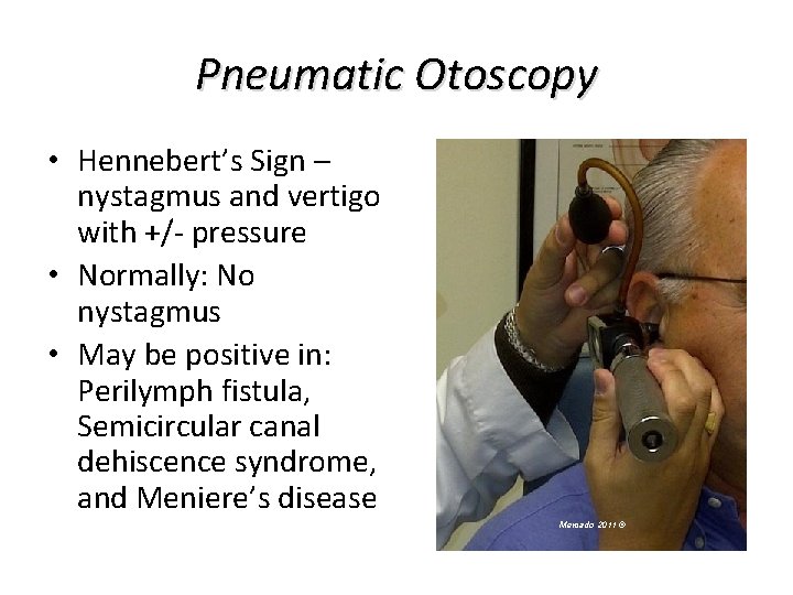 Pneumatic Otoscopy • Hennebert’s Sign – nystagmus and vertigo with +/- pressure • Normally: Pneumatic Otoscopy • Hennebert’s Sign – nystagmus and vertigo with +/- pressure • Normally: