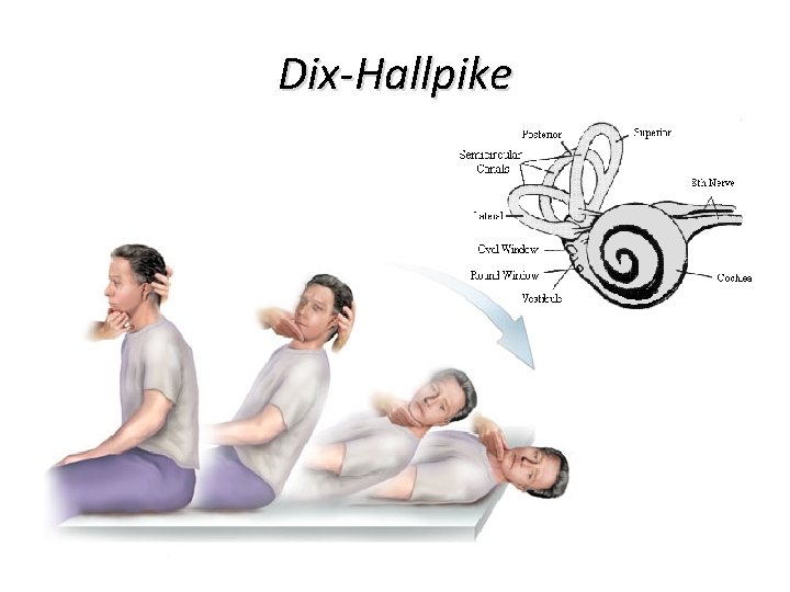 Dix-Hallpike Dix-Hallpike