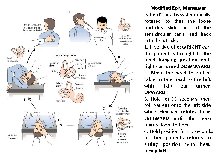 Modified Eply Maneuver Patient’s head is systematically rotated so that the loose particles slide Modified Eply Maneuver Patient’s head is systematically rotated so that the loose particles slide