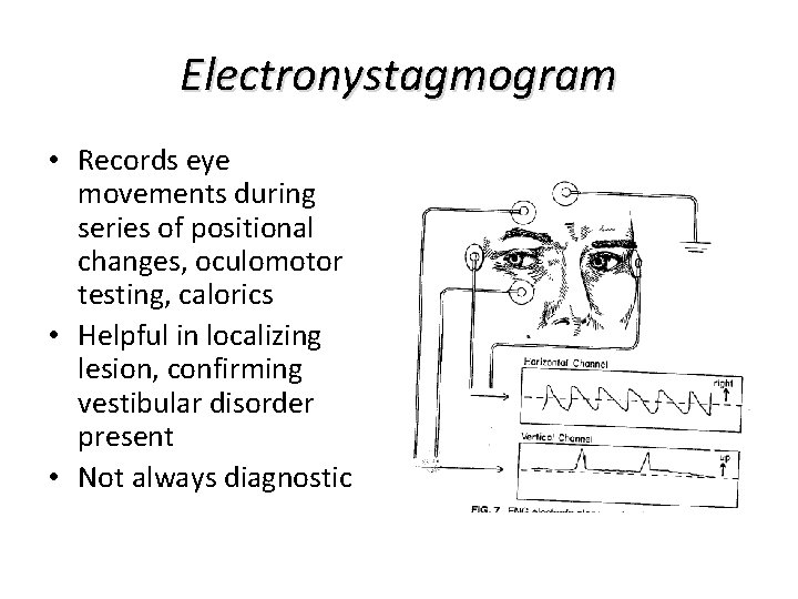 Electronystagmogram • Records eye movements during series of positional changes, oculomotor testing, calorics • Electronystagmogram • Records eye movements during series of positional changes, oculomotor testing, calorics •