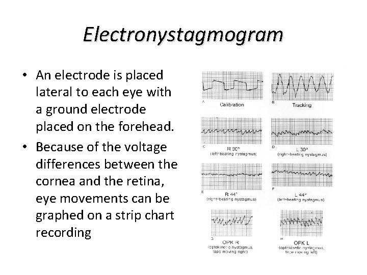 Electronystagmogram • An electrode is placed lateral to each eye with a ground electrode Electronystagmogram • An electrode is placed lateral to each eye with a ground electrode
