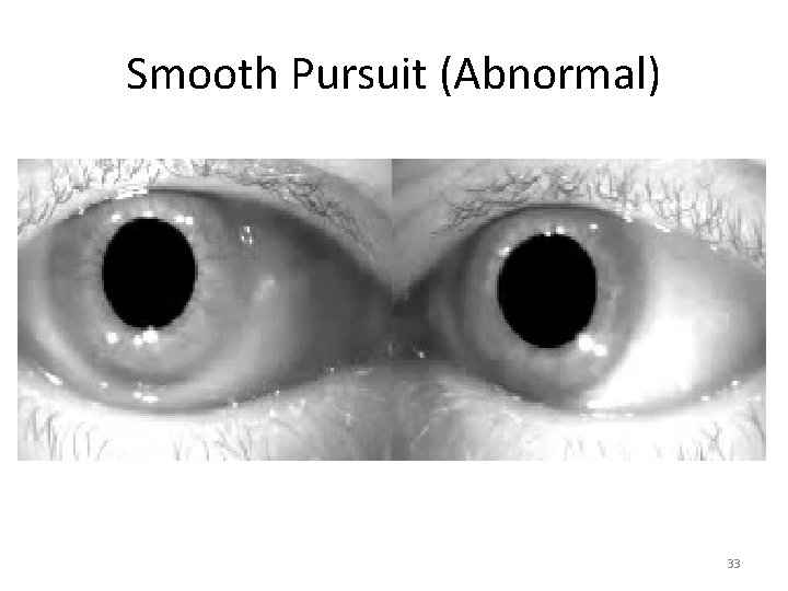 Smooth Pursuit (Abnormal) 33 Smooth Pursuit (Abnormal) 33