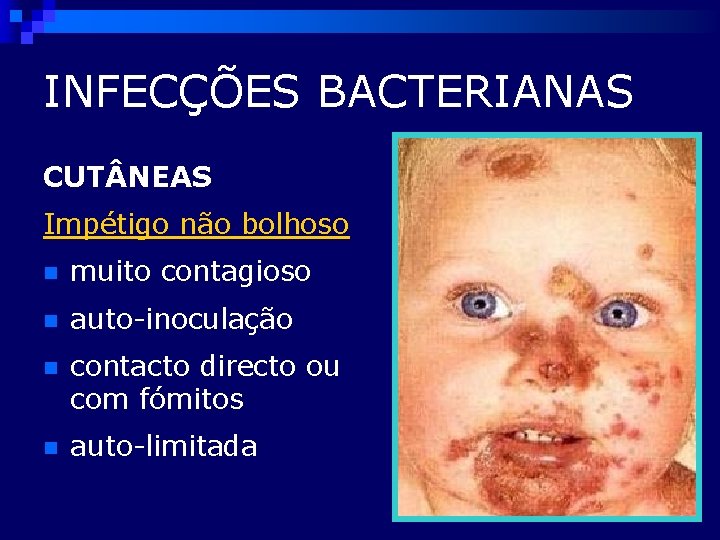 INFECÇÕES BACTERIANAS CUT NEAS Impétigo não bolhoso n muito contagioso n auto-inoculação n contacto