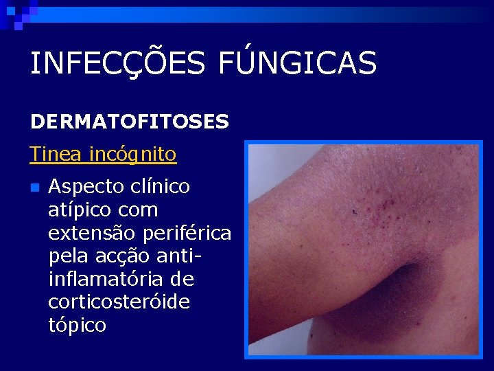 INFECÇÕES FÚNGICAS DERMATOFITOSES Tinea incógnito n Aspecto clínico atípico com extensão periférica pela acção