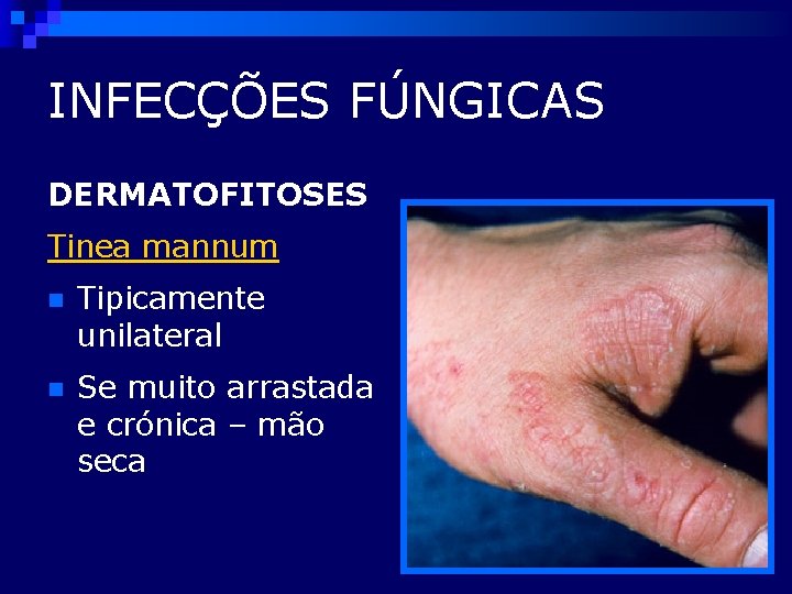 INFECÇÕES FÚNGICAS DERMATOFITOSES Tinea mannum n Tipicamente unilateral n Se muito arrastada e crónica