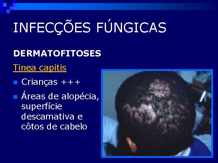 INFECÇÕES FÚNGICAS DERMATOFITOSES Tinea capitis n Crianças +++ n Áreas de alopécia, superfície descamativa