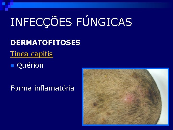 INFECÇÕES FÚNGICAS DERMATOFITOSES Tinea capitis n Quérion Forma inflamatória 