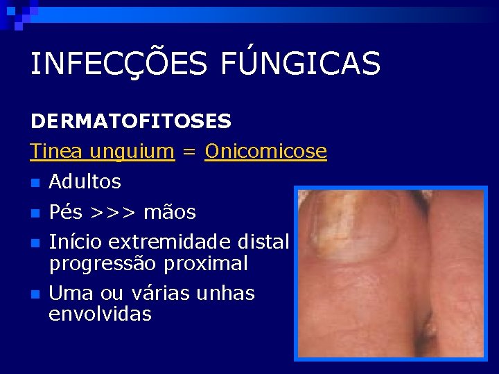 INFECÇÕES FÚNGICAS DERMATOFITOSES Tinea unguium = Onicomicose n Adultos n Pés >>> mãos n