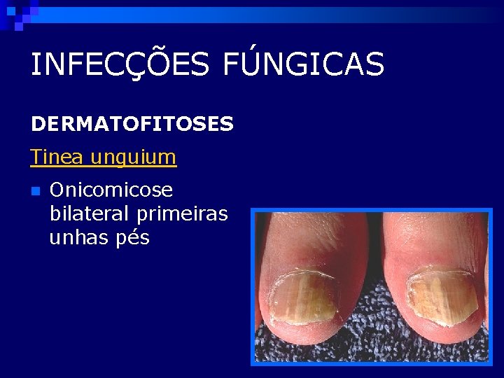 INFECÇÕES FÚNGICAS DERMATOFITOSES Tinea unguium n Onicomicose bilateral primeiras unhas pés 